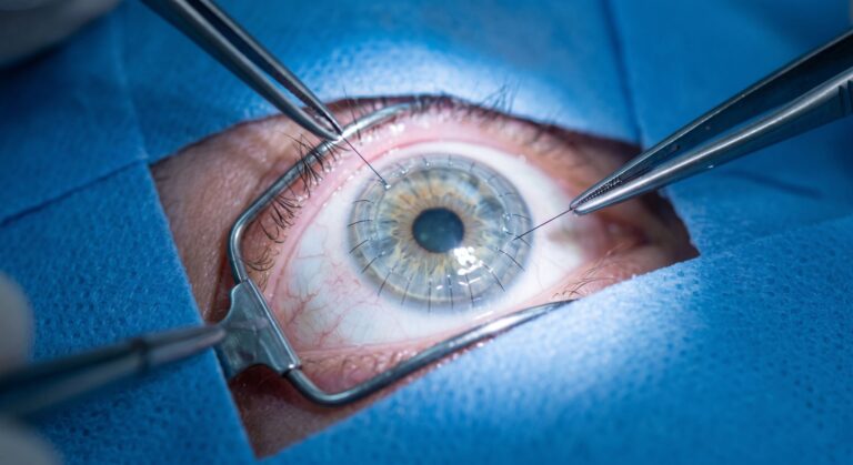 Trapianto di cornea a Roma: quando è necessario